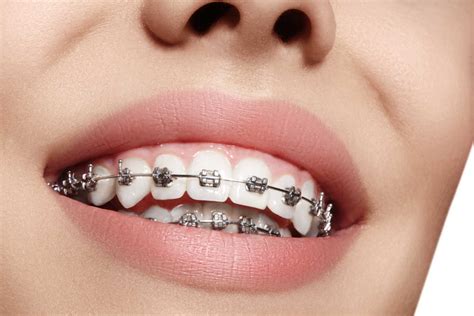 los brackets metalicos son buenos|brackets de metal.